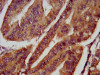 IHC image of CSB-PA822228LA01HU diluted at 1:800 and staining in paraffin-embedded human endometrial cancer performed on a Leica BondTM system. After dewaxing and hydration, antigen retrieval was mediated by high pressure in a citrate buffer (pH 6.0) . Section was blocked with 10% normal goat serum 30min at RT. Then primary antibody (1% BSA) was incubated at 4°C overnight. The primary is detected by a biotinylated secondary antibody and visualized using an HRP conjugated SP system.