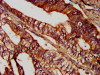 IHC image of CSB-PA846636LA01HU diluted at 1:300 and staining in paraffin-embedded human colon cancer performed on a Leica BondTM system. After dewaxing and hydration, antigen retrieval was mediated by high pressure in a citrate buffer (pH 6.0) . Section was blocked with 10% normal goat serum 30min at RT. Then primary antibody (1% BSA) was incubated at 4°C overnight. The primary is detected by a biotinylated secondary antibody and visualized using an HRP conjugated SP system.