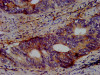 IHC image of CSB-PA848410LA01HU diluted at 1:500 and staining in paraffin-embedded human colon cancer performed on a Leica BondTM system. After dewaxing and hydration, antigen retrieval was mediated by high pressure in a citrate buffer (pH 6.0) . Section was blocked with 10% normal goat serum 30min at RT. Then primary antibody (1% BSA) was incubated at 4°C overnight. The primary is detected by a biotinylated secondary antibody and visualized using an HRP conjugated SP system.