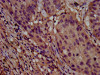 IHC image of CSB-PA850323LA01HU diluted at 1:800 and staining in paraffin-embedded human lung cancer performed on a Leica BondTM system. After dewaxing and hydration, antigen retrieval was mediated by high pressure in a citrate buffer (pH 6.0) . Section was blocked with 10% normal goat serum 30min at RT. Then primary antibody (1% BSA) was incubated at 4°C overnight. The primary is detected by a biotinylated secondary antibody and visualized using an HRP conjugated SP system.