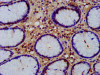 IHC image of CSB-PA863951LA01HU diluted at 1:200 and staining in paraffin-embedded human gastric cancer performed on a Leica BondTM system. After dewaxing and hydration, antigen retrieval was mediated by high pressure in a citrate buffer (pH 6.0) . Section was blocked with 10% normal goat serum 30min at RT. Then primary antibody (1% BSA) was incubated at 4°C overnight. The primary is detected by a biotinylated secondary antibody and visualized using an HRP conjugated SP system.