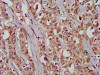 IHC image of CSB-PA863951LA01HU diluted at 1:200 and staining in paraffin-embedded human liver cancer performed on a Leica BondTM system. After dewaxing and hydration, antigen retrieval was mediated by high pressure in a citrate buffer (pH 6.0) . Section was blocked with 10% normal goat serum 30min at RT. Then primary antibody (1% BSA) was incubated at 4°C overnight. The primary is detected by a biotinylated secondary antibody and visualized using an HRP conjugated SP system.