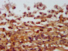 IHC image of CSB-PA866200LA01HU diluted at 1:400 and staining in paraffin-embedded human melanoma performed on a Leica BondTM system. After dewaxing and hydration, antigen retrieval was mediated by high pressure in a citrate buffer (pH 6.0) . Section was blocked with 10% normal goat serum 30min at RT. Then primary antibody (1% BSA) was incubated at 4°C overnight. The primary is detected by a biotinylated secondary antibody and visualized using an HRP conjugated SP system.