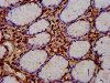 IHC image of CSB-PA873651LA01HU diluted at 1:400 and staining in paraffin-embedded human gastric cancer performed on a Leica BondTM system. After dewaxing and hydration, antigen retrieval was mediated by high pressure in a citrate buffer (pH 6.0) . Section was blocked with 10% normal goat serum 30min at RT. Then primary antibody (1% BSA) was incubated at 4°C overnight. The primary is detected by a biotinylated secondary antibody and visualized using an HRP conjugated SP system.
