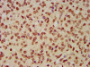 IHC image of CSB-PA010429OA12nbioHU diluted at 1:1 and staining in paraffin-embedded human glioma performed on a Leica BondTM system. After dewaxing and hydration, antigen retrieval was mediated by high pressure in a citrate buffer (pH 6.0) . Section was blocked with 10% normal goat serum 30min at RT. Then primary antibody (1% BSA) was incubated at 4°C overnight. The primary is detected by a biotinylated secondary antibody and visualized using an HRP conjugated SP system.