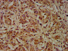 IHC image of CSB-PA006963LA01HU diluted at 1:200 and staining in paraffin-embedded human liver cancer performed on a Leica BondTM system. After dewaxing and hydration, antigen retrieval was mediated by high pressure in a citrate buffer (pH 6.0) . Section was blocked with 10% normal goat serum 30min at RT. Then primary antibody (1% BSA) was incubated at 4°C overnight. The primary is detected by a biotinylated secondary antibody and visualized using an HRP conjugated SP system.