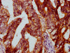 IHC image of CSB-PA007291LA01HU diluted at 1:500 and staining in paraffin-embedded human colon cancer performed on a Leica BondTM system. After dewaxing and hydration, antigen retrieval was mediated by high pressure in a citrate buffer (pH 6.0) . Section was blocked with 10% normal goat serum 30min at RT. Then primary antibody (1% BSA) was incubated at 4°C overnight. The primary is detected by a biotinylated secondary antibody and visualized using an HRP conjugated SP system.