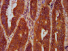 IHC image of CSB-PA009716LA01HU diluted at 1:300 and staining in paraffin-embedded human colon cancer performed on a Leica BondTM system. After dewaxing and hydration, antigen retrieval was mediated by high pressure in a citrate buffer (pH 6.0) . Section was blocked with 10% normal goat serum 30min at RT. Then primary antibody (1% BSA) was incubated at 4°C overnight. The primary is detected by a biotinylated secondary antibody and visualized using an HRP conjugated SP system.