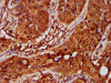 IHC image of CSB-PA011571LA01HU diluted at 1:600 and staining in paraffin-embedded human cervical cancer performed on a Leica BondTM system. After dewaxing and hydration, antigen retrieval was mediated by high pressure in a citrate buffer (pH 6.0) . Section was blocked with 10% normal goat serum 30min at RT. Then primary antibody (1% BSA) was incubated at 4°C overnight. The primary is detected by a biotinylated secondary antibody and visualized using an HRP conjugated SP system.