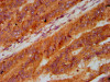 IHC image of CSB-PA012855LA01HU diluted at 1:400 and staining in paraffin-embedded human endometrial cancer performed on a Leica BondTM system. After dewaxing and hydration, antigen retrieval was mediated by high pressure in a citrate buffer (pH 6.0) . Section was blocked with 10% normal goat serum 30min at RT. Then primary antibody (1% BSA) was incubated at 4°C overnight. The primary is detected by a biotinylated secondary antibody and visualized using an HRP conjugated SP system.