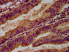 IHC image of CSB-PA013437LA01HU diluted at 1:500 and staining in paraffin-embedded human endometrial cancer performed on a Leica BondTM system. After dewaxing and hydration, antigen retrieval was mediated by high pressure in a citrate buffer (pH 6.0) . Section was blocked with 10% normal goat serum 30min at RT. Then primary antibody (1% BSA) was incubated at 4°C overnight. The primary is detected by a biotinylated secondary antibody and visualized using an HRP conjugated SP system.