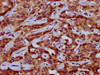 IHC image of CSB-PA017795LA01HU diluted at 1:200 and staining in paraffin-embedded human liver cancer performed on a Leica BondTM system. After dewaxing and hydration, antigen retrieval was mediated by high pressure in a citrate buffer (pH 6.0) . Section was blocked with 10% normal goat serum 30min at RT. Then primary antibody (1% BSA) was incubated at 4°C overnight. The primary is detected by a biotinylated secondary antibody and visualized using an HRP conjugated SP system.