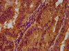 IHC image of CSB-PA017862LA01HU diluted at 1:300 and staining in paraffin-embedded human endometrial cancer performed on a Leica BondTM system. After dewaxing and hydration, antigen retrieval was mediated by high pressure in a citrate buffer (pH 6.0) . Section was blocked with 10% normal goat serum 30min at RT. Then primary antibody (1% BSA) was incubated at 4°C overnight. The primary is detected by a biotinylated secondary antibody and visualized using an HRP conjugated SP system.