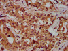 IHC image of CSB-PA017862LA01HU diluted at 1:300 and staining in paraffin-embedded human liver cancer performed on a Leica BondTM system. After dewaxing and hydration, antigen retrieval was mediated by high pressure in a citrate buffer (pH 6.0) . Section was blocked with 10% normal goat serum 30min at RT. Then primary antibody (1% BSA) was incubated at 4°C overnight. The primary is detected by a biotinylated secondary antibody and visualized using an HRP conjugated SP system.