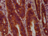 IHC image of CSB-PA020937LA01HU diluted at 1:400 and staining in paraffin-embedded human colon cancer performed on a Leica BondTM system. After dewaxing and hydration, antigen retrieval was mediated by high pressure in a citrate buffer (pH 6.0) . Section was blocked with 10% normal goat serum 30min at RT. Then primary antibody (1% BSA) was incubated at 4°C overnight. The primary is detected by a biotinylated secondary antibody and visualized using an HRP conjugated SP system.