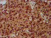 IHC image of CSB-PA021125LA01HU diluted at 1:200 and staining in paraffin-embedded human glioma performed on a Leica BondTM system. After dewaxing and hydration, antigen retrieval was mediated by high pressure in a citrate buffer (pH 6.0) . Section was blocked with 10% normal goat serum 30min at RT. Then primary antibody (1% BSA) was incubated at 4°C overnight. The primary is detected by a biotinylated secondary antibody and visualized using an HRP conjugated SP system.