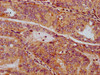 IHC image of CSB-PA022980LA01HU diluted at 1:300 and staining in paraffin-embedded human endometrial cancer performed on a Leica BondTM system. After dewaxing and hydration, antigen retrieval was mediated by high pressure in a citrate buffer (pH 6.0) . Section was blocked with 10% normal goat serum 30min at RT. Then primary antibody (1% BSA) was incubated at 4°C overnight. The primary is detected by a biotinylated secondary antibody and visualized using an HRP conjugated SP system.