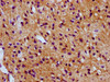 IHC image of CSB-PA022980LA01HU diluted at 1:300 and staining in paraffin-embedded human glioma performed on a Leica BondTM system. After dewaxing and hydration, antigen retrieval was mediated by high pressure in a citrate buffer (pH 6.0) . Section was blocked with 10% normal goat serum 30min at RT. Then primary antibody (1% BSA) was incubated at 4°C overnight. The primary is detected by a biotinylated secondary antibody and visualized using an HRP conjugated SP system.