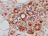 IHC image of CSB-PA026651LA01HU diluted at 1:300 and staining in paraffin-embedded human breast cancer performed on a Leica BondTM system. After dewaxing and hydration, antigen retrieval was mediated by high pressure in a citrate buffer (pH 6.0) . Section was blocked with 10% normal goat serum 30min at RT. Then primary antibody (1% BSA) was incubated at 4°C overnight. The primary is detected by a biotinylated secondary antibody and visualized using an HRP conjugated SP system.