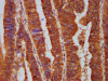 IHC image of CSB-PA619075LA01HU diluted at 1:500 and staining in paraffin-embedded human colon cancer performed on a Leica BondTM system. After dewaxing and hydration, antigen retrieval was mediated by high pressure in a citrate buffer (pH 6.0) . Section was blocked with 10% normal goat serum 30min at RT. Then primary antibody (1% BSA) was incubated at 4°C overnight. The primary is detected by a biotinylated secondary antibody and visualized using an HRP conjugated SP system.