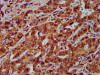 IHC image of CSB-PA623897LA01HU diluted at 1:200 and staining in paraffin-embedded human liver cancer performed on a Leica BondTM system. After dewaxing and hydration, antigen retrieval was mediated by high pressure in a citrate buffer (pH 6.0) . Section was blocked with 10% normal goat serum 30min at RT. Then primary antibody (1% BSA) was incubated at 4°C overnight. The primary is detected by a biotinylated secondary antibody and visualized using an HRP conjugated SP system.