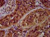 IHC image of CSB-PA681513LA01HU diluted at 1:600 and staining in paraffin-embedded human cervical cancer performed on a Leica BondTM system. After dewaxing and hydration, antigen retrieval was mediated by high pressure in a citrate buffer (pH 6.0) . Section was blocked with 10% normal goat serum 30min at RT. Then primary antibody (1% BSA) was incubated at 4°C overnight. The primary is detected by a biotinylated secondary antibody and visualized using an HRP conjugated SP system.