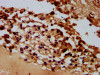 IHC image of CSB-PA681513LA01HU diluted at 1:600 and staining in paraffin-embedded human melanoma performed on a Leica BondTM system. After dewaxing and hydration, antigen retrieval was mediated by high pressure in a citrate buffer (pH 6.0) . Section was blocked with 10% normal goat serum 30min at RT. Then primary antibody (1% BSA) was incubated at 4°C overnight. The primary is detected by a biotinylated secondary antibody and visualized using an HRP conjugated SP system.