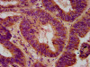 IHC image of CSB-PA740224LA01HU diluted at 1:500 and staining in paraffin-embedded human colon cancer performed on a Leica BondTM system. After dewaxing and hydration, antigen retrieval was mediated by high pressure in a citrate buffer (pH 6.0) . Section was blocked with 10% normal goat serum 30min at RT. Then primary antibody (1% BSA) was incubated at 4°C overnight. The primary is detected by a biotinylated secondary antibody and visualized using an HRP conjugated SP system.