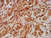 IHC image of CSB-PA740224LA01HU diluted at 1:500 and staining in paraffin-embedded human liver cancer performed on a Leica BondTM system. After dewaxing and hydration, antigen retrieval was mediated by high pressure in a citrate buffer (pH 6.0) . Section was blocked with 10% normal goat serum 30min at RT. Then primary antibody (1% BSA) was incubated at 4°C overnight. The primary is detected by a biotinylated secondary antibody and visualized using an HRP conjugated SP system.