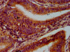 IHC image of CSB-PA757083LA01HU diluted at 1:600 and staining in paraffin-embedded human endometrial cancer performed on a Leica BondTM system. After dewaxing and hydration, antigen retrieval was mediated by high pressure in a citrate buffer (pH 6.0) . Section was blocked with 10% normal goat serum 30min at RT. Then primary antibody (1% BSA) was incubated at 4°C overnight. The primary is detected by a biotinylated secondary antibody and visualized using an HRP conjugated SP system.