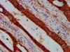 IHC image of CSB-PA768235LA01HU diluted at 1:600 and staining in paraffin-embedded human colon cancer performed on a Leica BondTM system. After dewaxing and hydration, antigen retrieval was mediated by high pressure in a citrate buffer (pH 6.0) . Section was blocked with 10% normal goat serum 30min at RT. Then primary antibody (1% BSA) was incubated at 4°C overnight. The primary is detected by a biotinylated secondary antibody and visualized using an HRP conjugated SP system.
