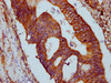 IHC image of CSB-PA769767LA01HU diluted at 1:500 and staining in paraffin-embedded human colon cancer performed on a Leica BondTM system. After dewaxing and hydration, antigen retrieval was mediated by high pressure in a citrate buffer (pH 6.0) . Section was blocked with 10% normal goat serum 30min at RT. Then primary antibody (1% BSA) was incubated at 4°C overnight. The primary is detected by a biotinylated secondary antibody and visualized using an HRP conjugated SP system.