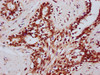 IHC image of CSB-PA835687LA01HU diluted at 1:400 and staining in paraffin-embedded human breast cancer performed on a Leica BondTM system. After dewaxing and hydration, antigen retrieval was mediated by high pressure in a citrate buffer (pH 6.0) . Section was blocked with 10% normal goat serum 30min at RT. Then primary antibody (1% BSA) was incubated at 4°C overnight. The primary is detected by a biotinylated secondary antibody and visualized using an HRP conjugated SP system.