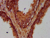 IHC image of CSB-PA842128LA01HU diluted at 1:600 and staining in paraffin-embedded human prostate cancer performed on a Leica BondTM system. After dewaxing and hydration, antigen retrieval was mediated by high pressure in a citrate buffer (pH 6.0) . Section was blocked with 10% normal goat serum 30min at RT. Then primary antibody (1% BSA) was incubated at 4°C overnight. The primary is detected by a biotinylated secondary antibody and visualized using an HRP conjugated SP system.