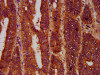 IHC image of CSB-PA842128LA01HU diluted at 1:600 and staining in paraffin-embedded human colon cancer performed on a Leica BondTM system. After dewaxing and hydration, antigen retrieval was mediated by high pressure in a citrate buffer (pH 6.0) . Section was blocked with 10% normal goat serum 30min at RT. Then primary antibody (1% BSA) was incubated at 4°C overnight. The primary is detected by a biotinylated secondary antibody and visualized using an HRP conjugated SP system.