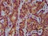 IHC image of CSB-PA883373LA01HU diluted at 1:400 and staining in paraffin-embedded human liver cancer performed on a Leica BondTM system. After dewaxing and hydration, antigen retrieval was mediated by high pressure in a citrate buffer (pH 6.0) . Section was blocked with 10% normal goat serum 30min at RT. Then primary antibody (1% BSA) was incubated at 4°C overnight. The primary is detected by a biotinylated secondary antibody and visualized using an HRP conjugated SP system.