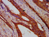 IHC image of CSB-PA883386LA01HU diluted at 1:200 and staining in paraffin-embedded human colon cancer performed on a Leica BondTM system. After dewaxing and hydration, antigen retrieval was mediated by high pressure in a citrate buffer (pH 6.0) . Section was blocked with 10% normal goat serum 30min at RT. Then primary antibody (1% BSA) was incubated at 4°C overnight. The primary is detected by a biotinylated secondary antibody and visualized using an HRP conjugated SP system.