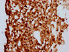 IHC image of CSB-PA891962LA01HU diluted at 1:500 and staining in paraffin-embedded human melanoma performed on a Leica BondTM system. After dewaxing and hydration, antigen retrieval was mediated by high pressure in a citrate buffer (pH 6.0) . Section was blocked with 10% normal goat serum 30min at RT. Then primary antibody (1% BSA) was incubated at 4°C overnight. The primary is detected by a biotinylated secondary antibody and visualized using an HRP conjugated SP system.