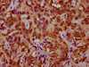 IHC image of CSB-PA010429OA79nforHU diluted at 1:5 and staining in paraffin-embedded human liver cancer performed on a Leica BondTM system. After dewaxing and hydration, antigen retrieval was mediated by high pressure in a citrate buffer (pH 6.0) . Section was blocked with 10% normal goat serum 30min at RT. Then primary antibody (1% BSA) was incubated at 4°C overnight. The primary is detected by a biotinylated secondary antibody and visualized using an HRP conjugated SP system.