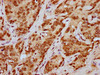 IHC image of CSB-PA010429OA79npropHU diluted at 1:20 and staining in paraffin-embedded human liver cancer performed on a Leica BondTM system. After dewaxing and hydration, antigen retrieval was mediated by high pressure in a citrate buffer (pH 6.0) . Section was blocked with 10% normal goat serum 30min at RT. Then primary antibody (1% BSA) was incubated at 4°C overnight. The primary is detected by a biotinylated secondary antibody and visualized using an HRP conjugated SP system.