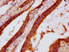 IHC image of CSB-PA006844LA01HU diluted at 1:600 and staining in paraffin-embedded human colon cancer performed on a Leica BondTM system. After dewaxing and hydration, antigen retrieval was mediated by high pressure in a citrate buffer (pH 6.0) . Section was blocked with 10% normal goat serum 30min at RT. Then primary antibody (1% BSA) was incubated at 4°C overnight. The primary is detected by a biotinylated secondary antibody and visualized using an HRP conjugated SP system.