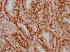 IHC image of CSB-PA010663LA01HU diluted at 1:600 and staining in paraffin-embedded human prostate cancer performed on a Leica BondTM system. After dewaxing and hydration, antigen retrieval was mediated by high pressure in a citrate buffer (pH 6.0) . Section was blocked with 10% normal goat serum 30min at RT. Then primary antibody (1% BSA) was incubated at 4°C overnight. The primary is detected by a biotinylated secondary antibody and visualized using an HRP conjugated SP system. IHC image of CSB-PA010663LA01HU diluted at 1:600 and staining in paraffin-embedded human prostate cancer performed on a Leica BondTM system. After dewaxing and hydration, antigen retrieval was mediated by high pressure in a citrate buffer (pH 6.0) . Section was blocked with 10% normal goat serum 30min at RT. Then primary antibody (1% BSA) was incubated at 4°C overnight. The primary is detected by a biotinylated secondary antibody and visualized using an HRP conjugated SP system.