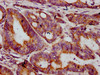 IHC image of CSB-PA015073LA01HU diluted at 1:400 and staining in paraffin-embedded human colon cancer performed on a Leica BondTM system. After dewaxing and hydration, antigen retrieval was mediated by high pressure in a citrate buffer (pH 6.0) . Section was blocked with 10% normal goat serum 30min at RT. Then primary antibody (1% BSA) was incubated at 4°C overnight. The primary is detected by a biotinylated secondary antibody and visualized using an HRP conjugated SP system.