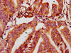 IHC image of CSB-PA015201LA01HU diluted at 1:400 and staining in paraffin-embedded human endometrial cancer performed on a Leica BondTM system. After dewaxing and hydration, antigen retrieval was mediated by high pressure in a citrate buffer (pH 6.0) . Section was blocked with 10% normal goat serum 30min at RT. Then primary antibody (1% BSA) was incubated at 4°C overnight. The primary is detected by a biotinylated secondary antibody and visualized using an HRP conjugated SP system.