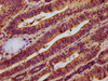 IHC image of CSB-PA015417LA01HU diluted at 1:500 and staining in paraffin-embedded human colon cancer performed on a Leica BondTM system. After dewaxing and hydration, antigen retrieval was mediated by high pressure in a citrate buffer (pH 6.0) . Section was blocked with 10% normal goat serum 30min at RT. Then primary antibody (1% BSA) was incubated at 4°C overnight. The primary is detected by a biotinylated secondary antibody and visualized using an HRP conjugated SP system.