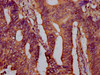 IHC image of CSB-PA019045LA01HU diluted at 1:400 and staining in paraffin-embedded human colon cancer performed on a Leica BondTM system. After dewaxing and hydration, antigen retrieval was mediated by high pressure in a citrate buffer (pH 6.0) . Section was blocked with 10% normal goat serum 30min at RT. Then primary antibody (1% BSA) was incubated at 4°C overnight. The primary is detected by a biotinylated secondary antibody and visualized using an HRP conjugated SP system.
