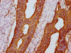 IHC image of CSB-PA23149A0Rb diluted at 1:600 and staining in paraffin-embedded human colon cancer performed on a Leica BondTM system. After dewaxing and hydration, antigen retrieval was mediated by high pressure in a citrate buffer (pH 6.0) . Section was blocked with 10% normal goat serum 30min at RT. Then primary antibody (1% BSA) was incubated at 4°C overnight. The primary is detected by a biotinylated secondary antibody and visualized using an HRP conjugated SP system.