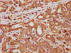IHC image of CSB-PA621868LA01HU diluted at 1:300 and staining in paraffin-embedded human liver cancer performed on a Leica BondTM system. After dewaxing and hydration, antigen retrieval was mediated by high pressure in a citrate buffer (pH 6.0) . Section was blocked with 10% normal goat serum 30min at RT. Then primary antibody (1% BSA) was incubated at 4°C overnight. The primary is detected by a biotinylated secondary antibody and visualized using an HRP conjugated SP system.