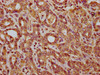 IHC image of CSB-PA703583LA01HU diluted at 1:200 and staining in paraffin-embedded human liver cancer performed on a Leica BondTM system. After dewaxing and hydration, antigen retrieval was mediated by high pressure in a citrate buffer (pH 6.0) . Section was blocked with 10% normal goat serum 30min at RT. Then primary antibody (1% BSA) was incubated at 4°C overnight. The primary is detected by a biotinylated secondary antibody and visualized using an HRP conjugated SP system.