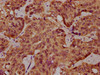 IHC image of CSB-PA707717LA01HU diluted at 1:400 and staining in paraffin-embedded human liver cancer performed on a Leica BondTM system. After dewaxing and hydration, antigen retrieval was mediated by high pressure in a citrate buffer (pH 6.0) . Section was blocked with 10% normal goat serum 30min at RT. Then primary antibody (1% BSA) was incubated at 4°C overnight. The primary is detected by a biotinylated secondary antibody and visualized using an HRP conjugated SP system.